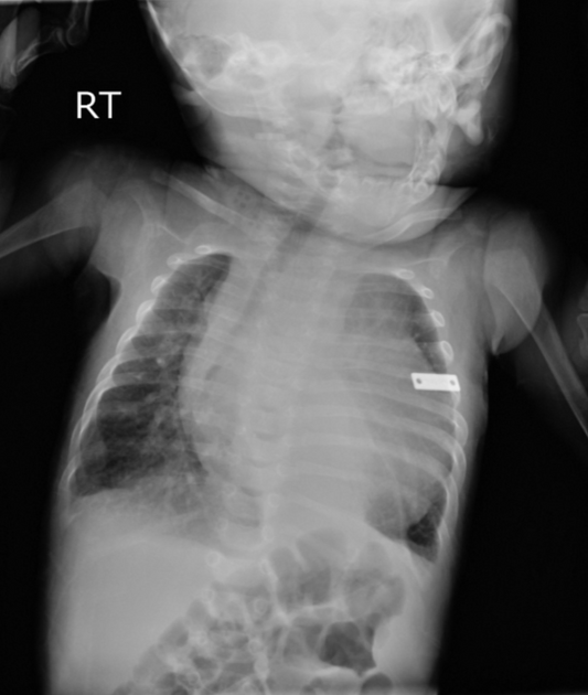 Chest X-ray showing severe infant cardiomegaly in an ALCAPA case